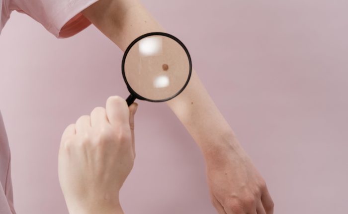 melanoma