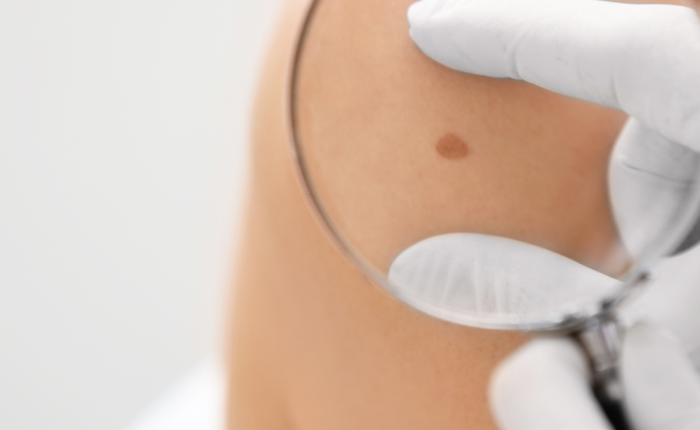 Melanoma