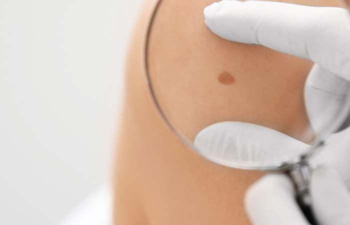 Melanoma