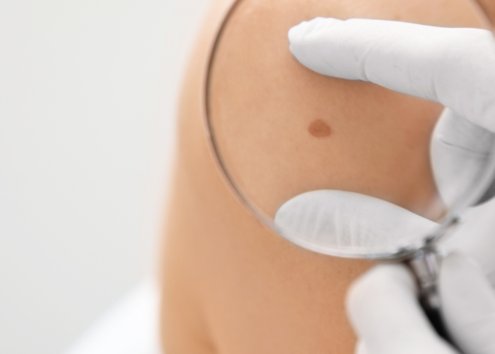 Melanoma