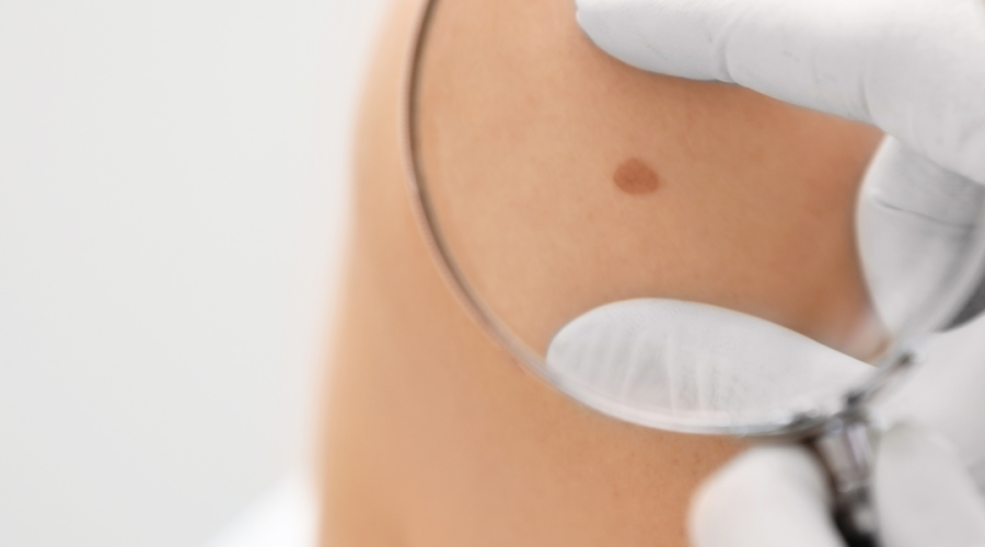 Melanoma