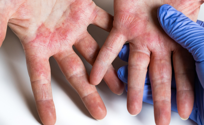 Atopiskais dermatīts