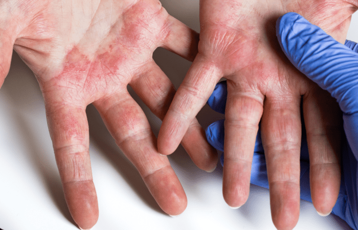 Atopiskais dermatīts