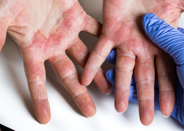 Biobank Hearts cilmes šūnu banka Atopiskais dermatīts