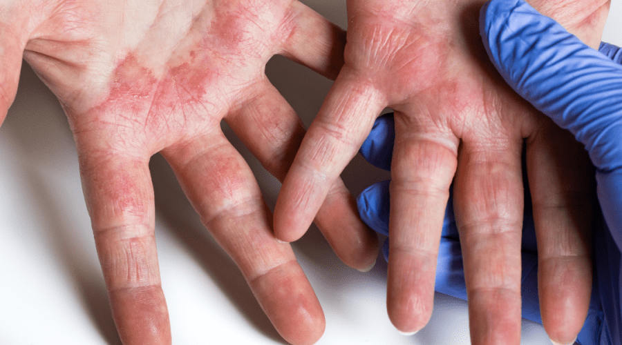 Atopiskais dermatīts