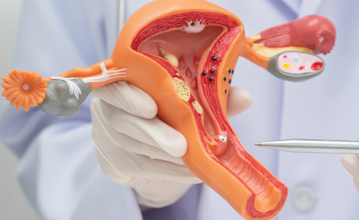 Olnīcu vēža ārstēšana