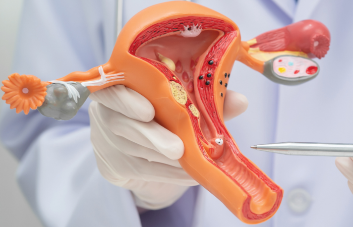 Olnīcu vēža ārstēšana