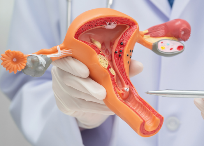 Biobank Hearts Olnīcu vēža ārstēšana