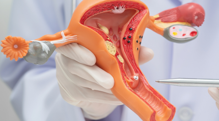 Olnīcu vēža ārstēšana